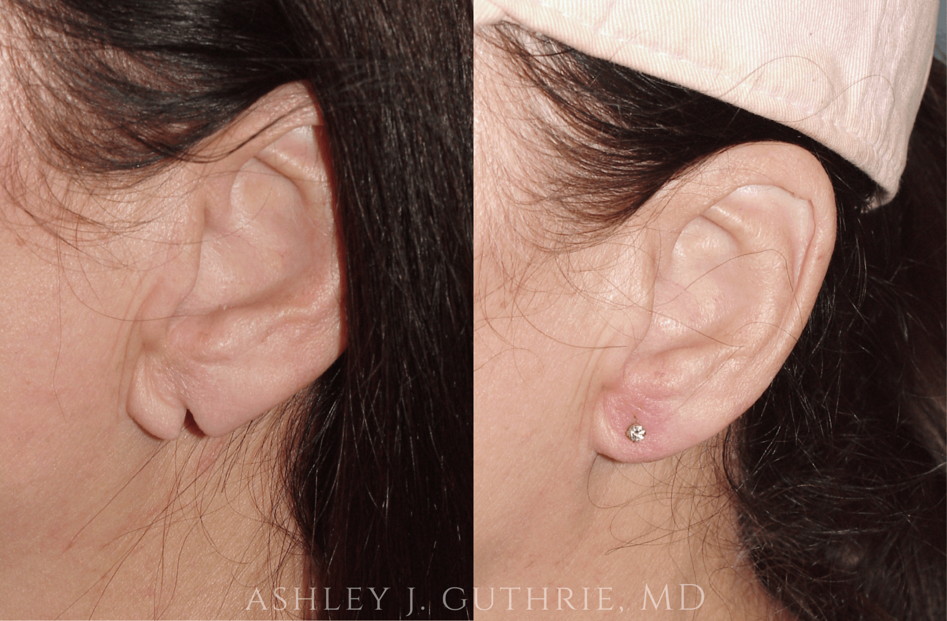 closeup of woman's ears before and after earlobe repair