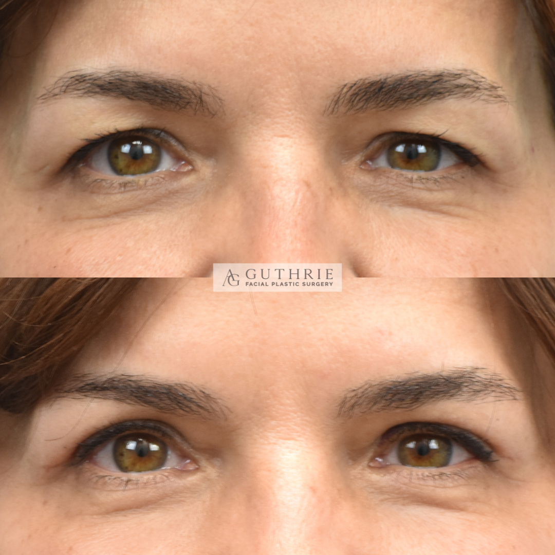 Before and After Upper Blepharoplasty