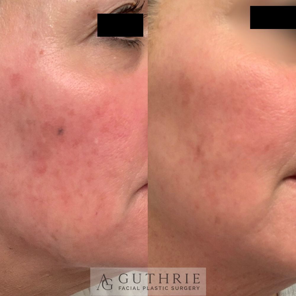 Before and After Tetra CO2 Laser Resurfacing Treatment