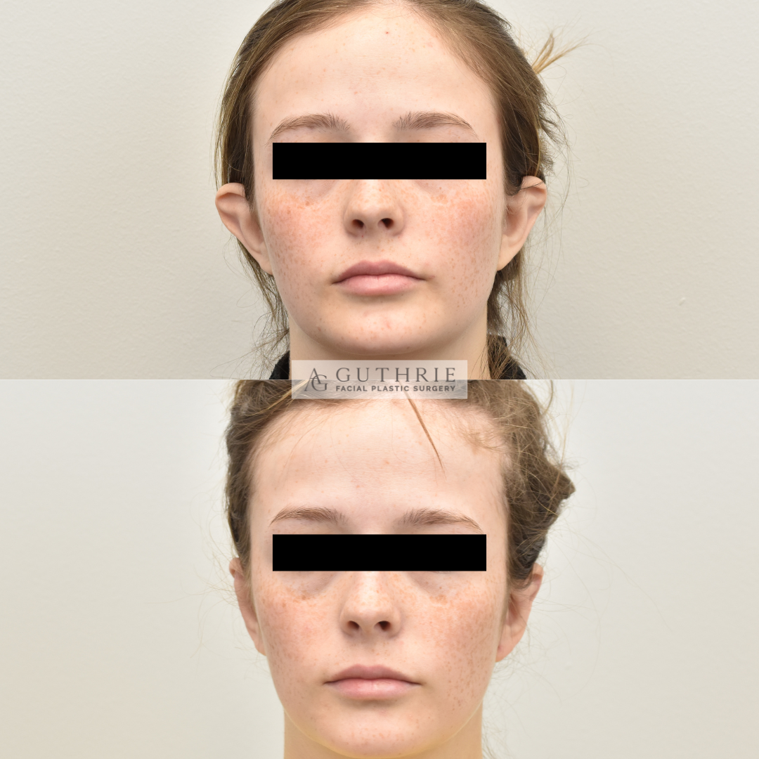 Before and After Stahl's Ear Reconstruction at Guthrie Facial Plastic Surgery 