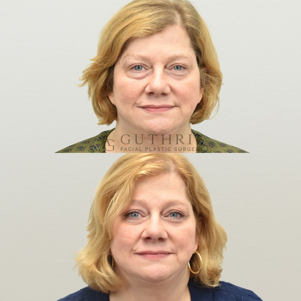 a woman's face shown before and after lower blepharoplasty