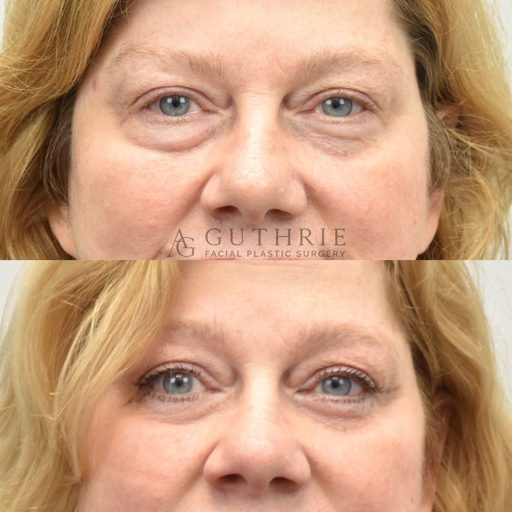 Before and After Lower Blepharoplasty