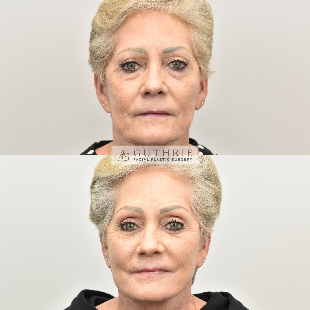 Before and After Brow Lift
