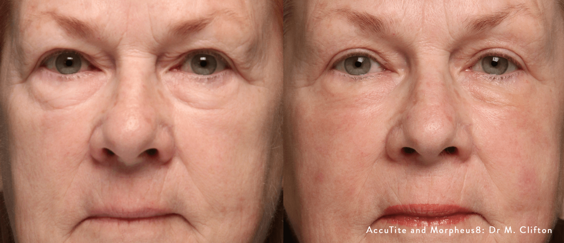 closeup of patient's face before and after morpheus8 treatment