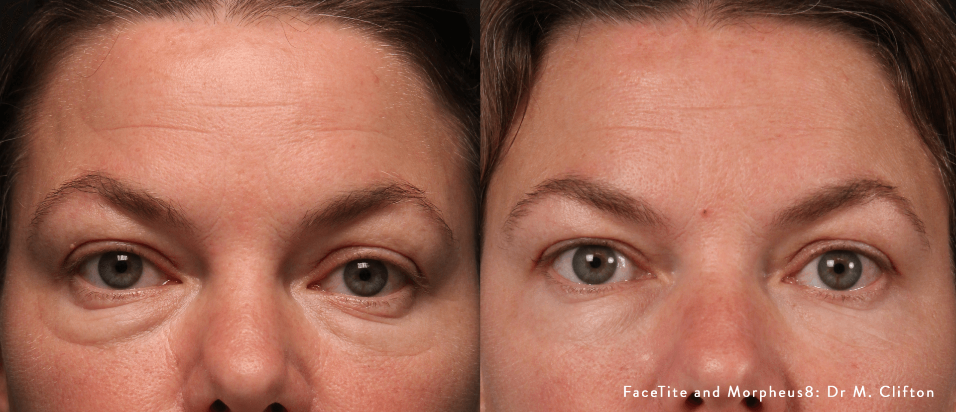 Facetite - Before & After