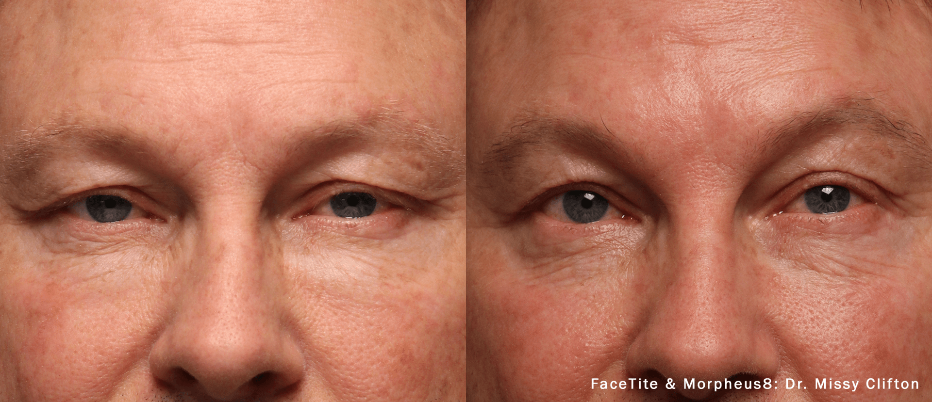 closeup of patient's face before and after Morpheus8 treatment