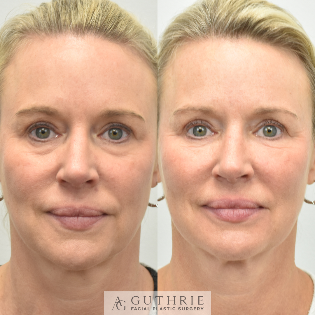 before and after lower blepharoplasty procedure at guthrie facial plastic surgery in brentwood tn