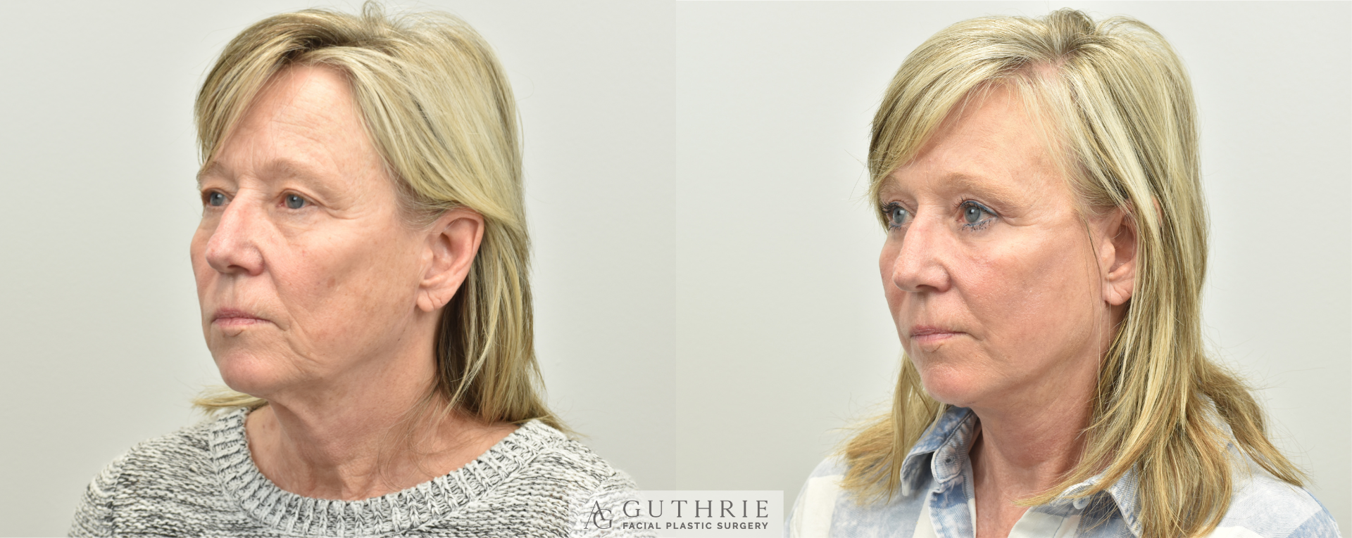 patient before and after face and neck lift at guthrie facial plastic surgery in brentwood tn
