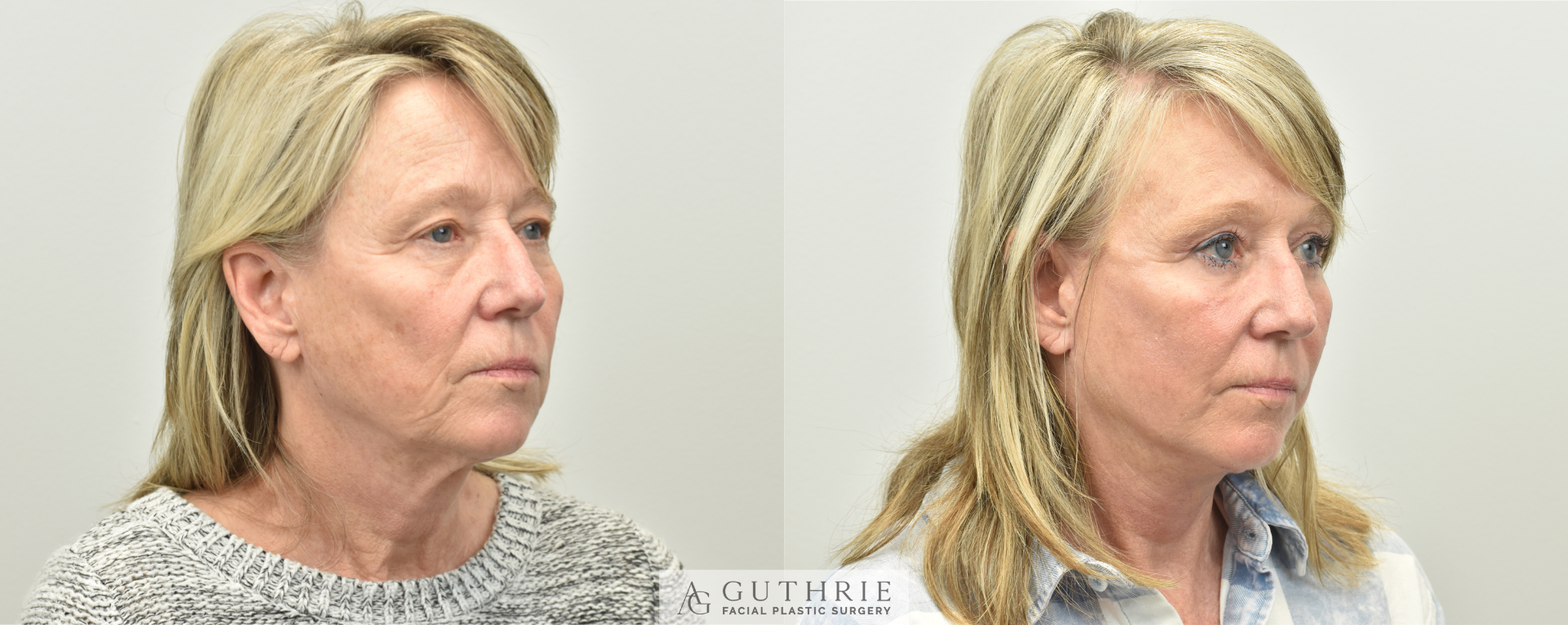 patient before and after face and neck lift at guthrie facial plastic surgery in brentwood tn