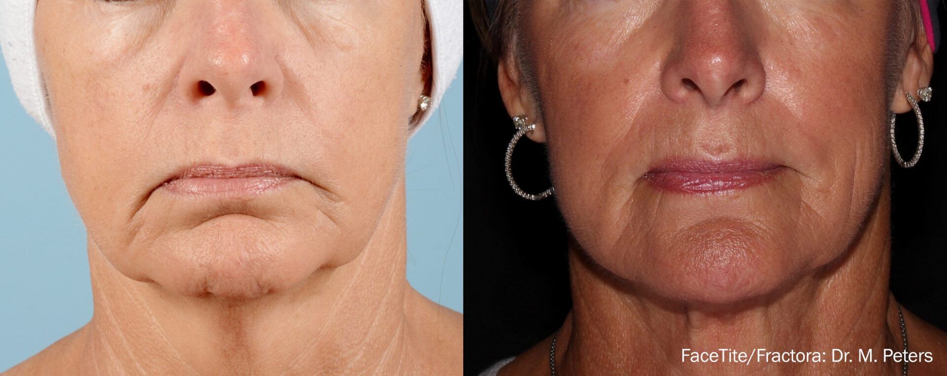woman's under-chin before and after FaceTite treatment