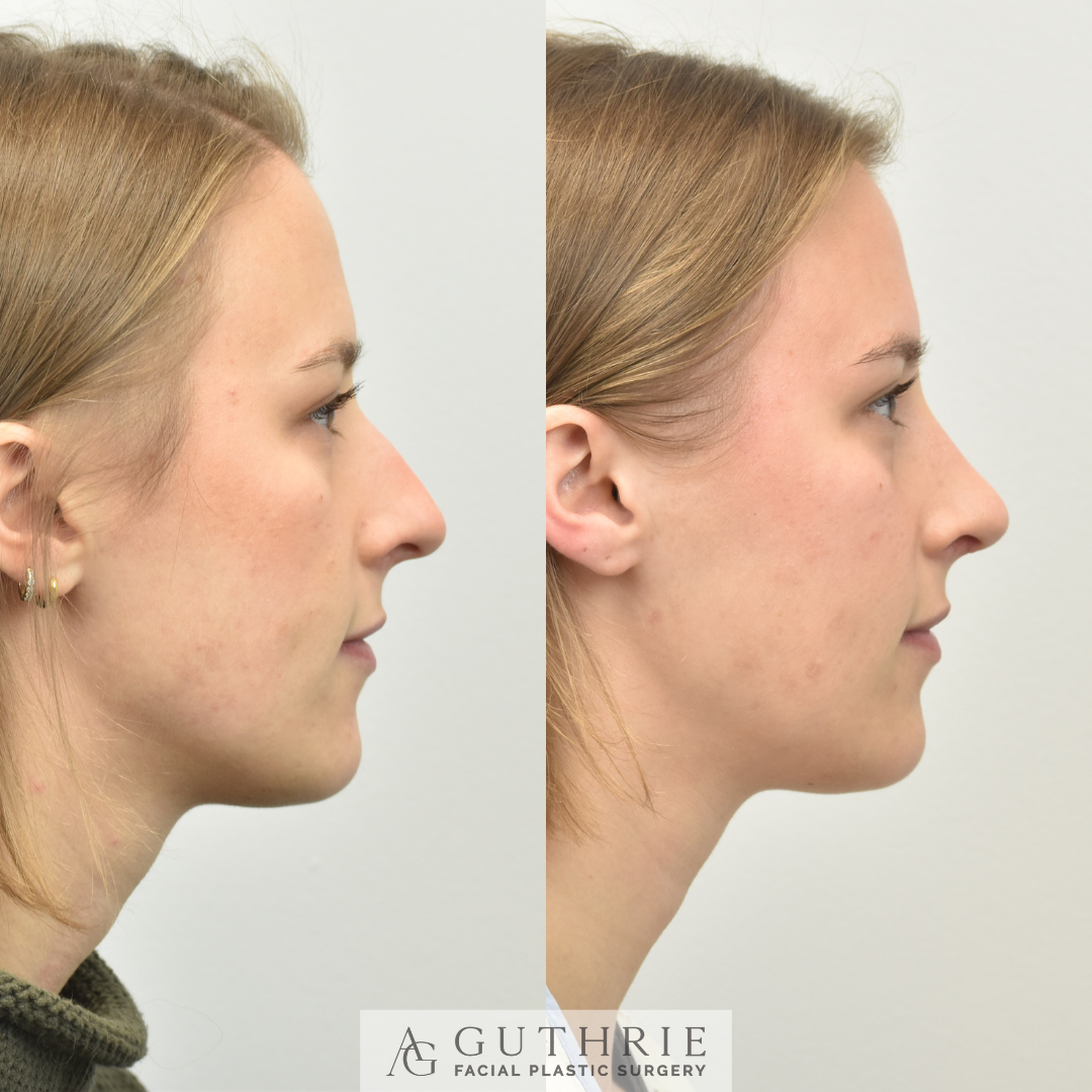 patient before and after rhinoplasty in brentwood, tn at guthrie facial plastic surgery