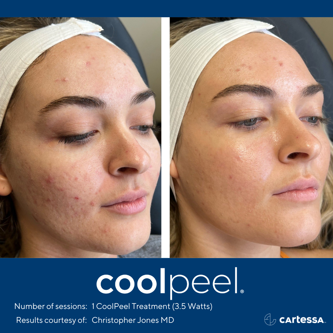 woman's face before and after CoolPeel treatment