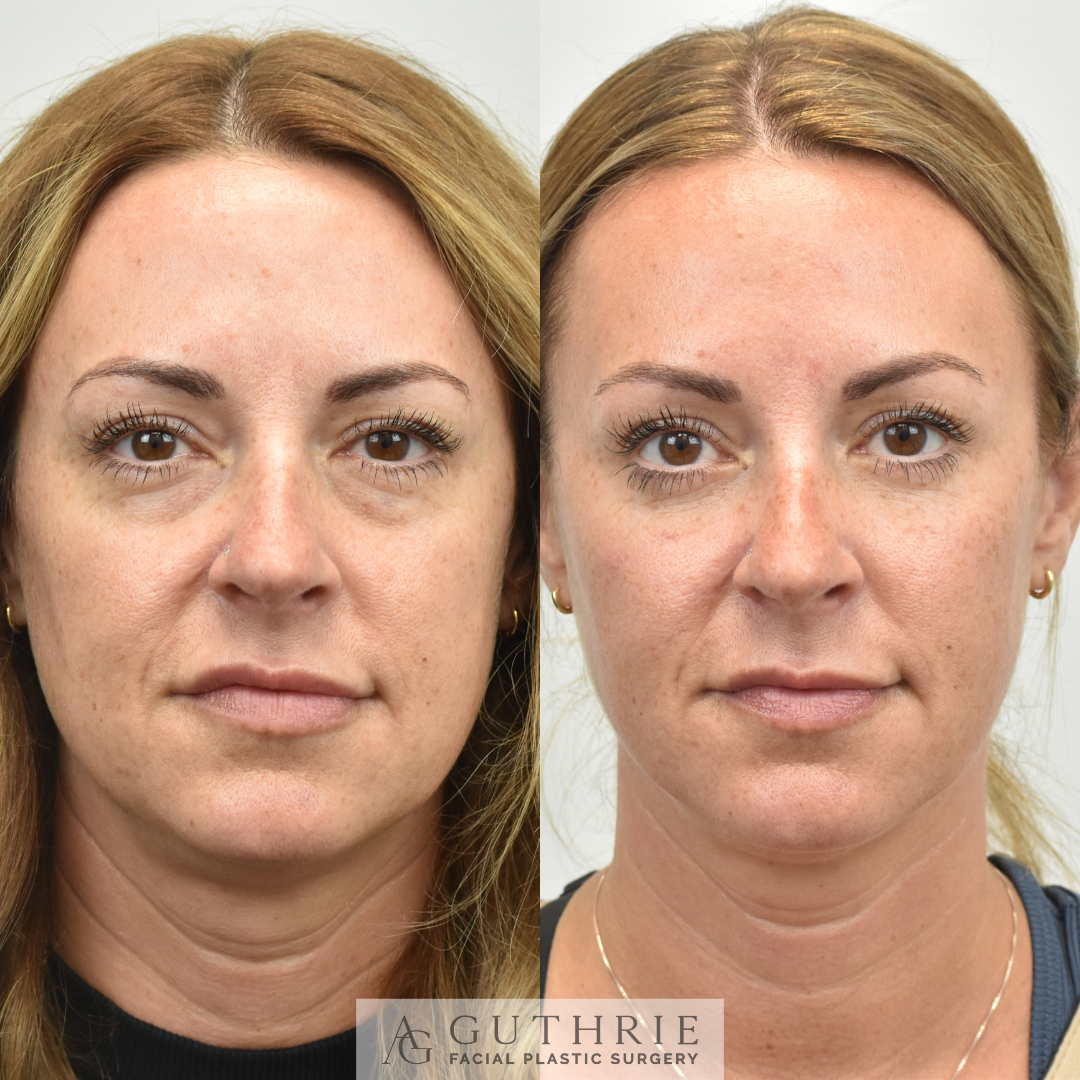 patient before and after lower blepharoplasty with fat transfer at guthrie facial plastic surgery in Brentwood tn
