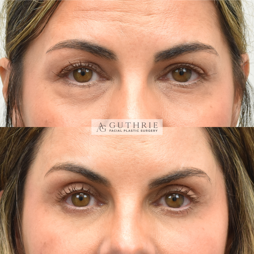 Before and After Upper and Lower Blepharoplasty