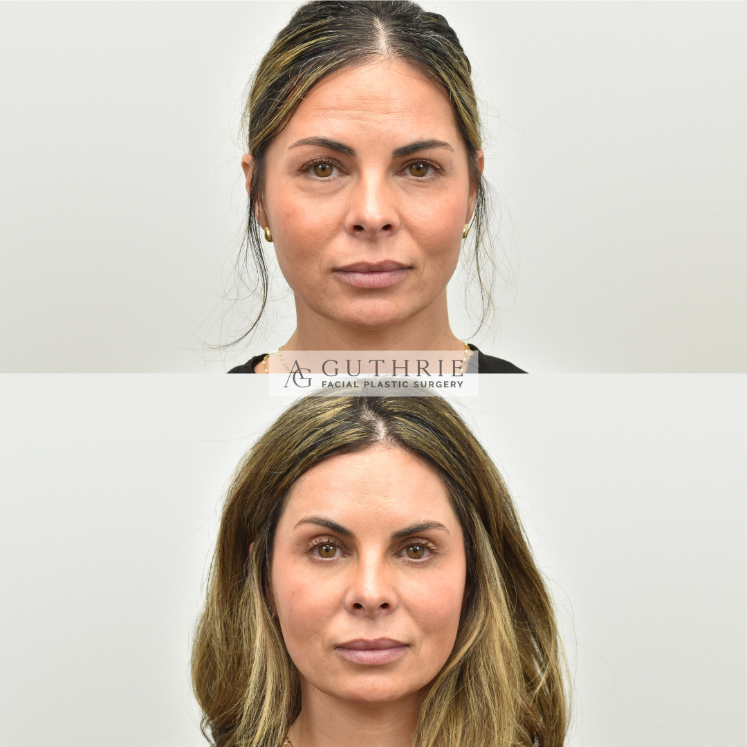 Before and After Brow Lift