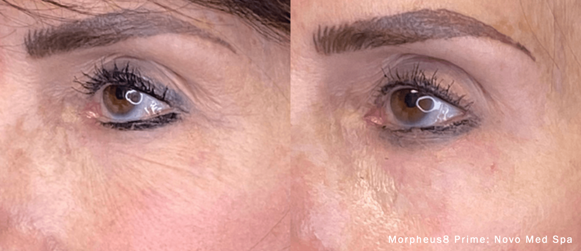 a patient before and after Morpheus8 treatment