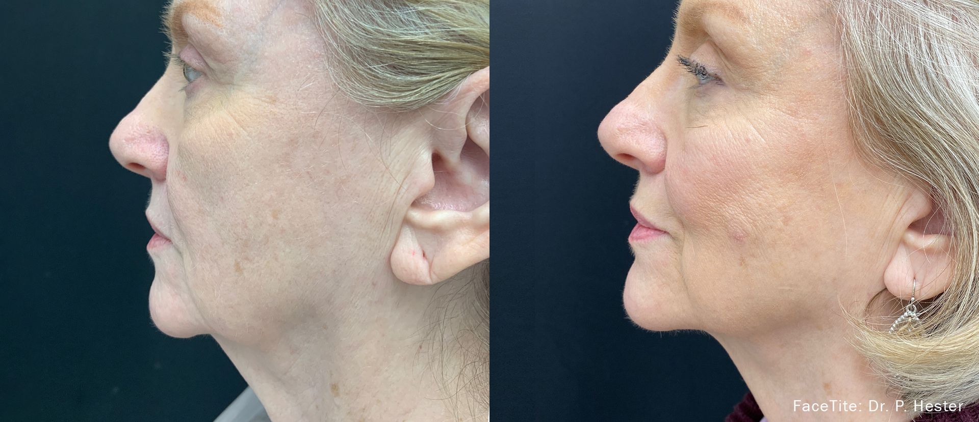 a patient shown before and after FaceTite treatment