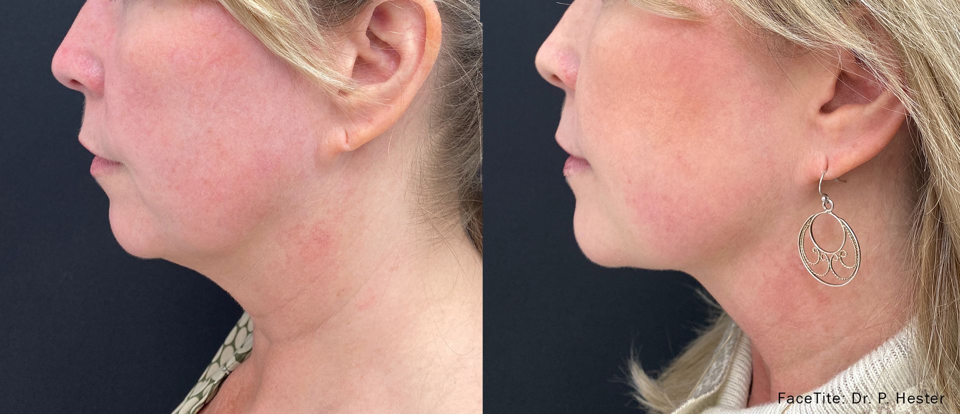 a patient shown before and after FaceTite treatment