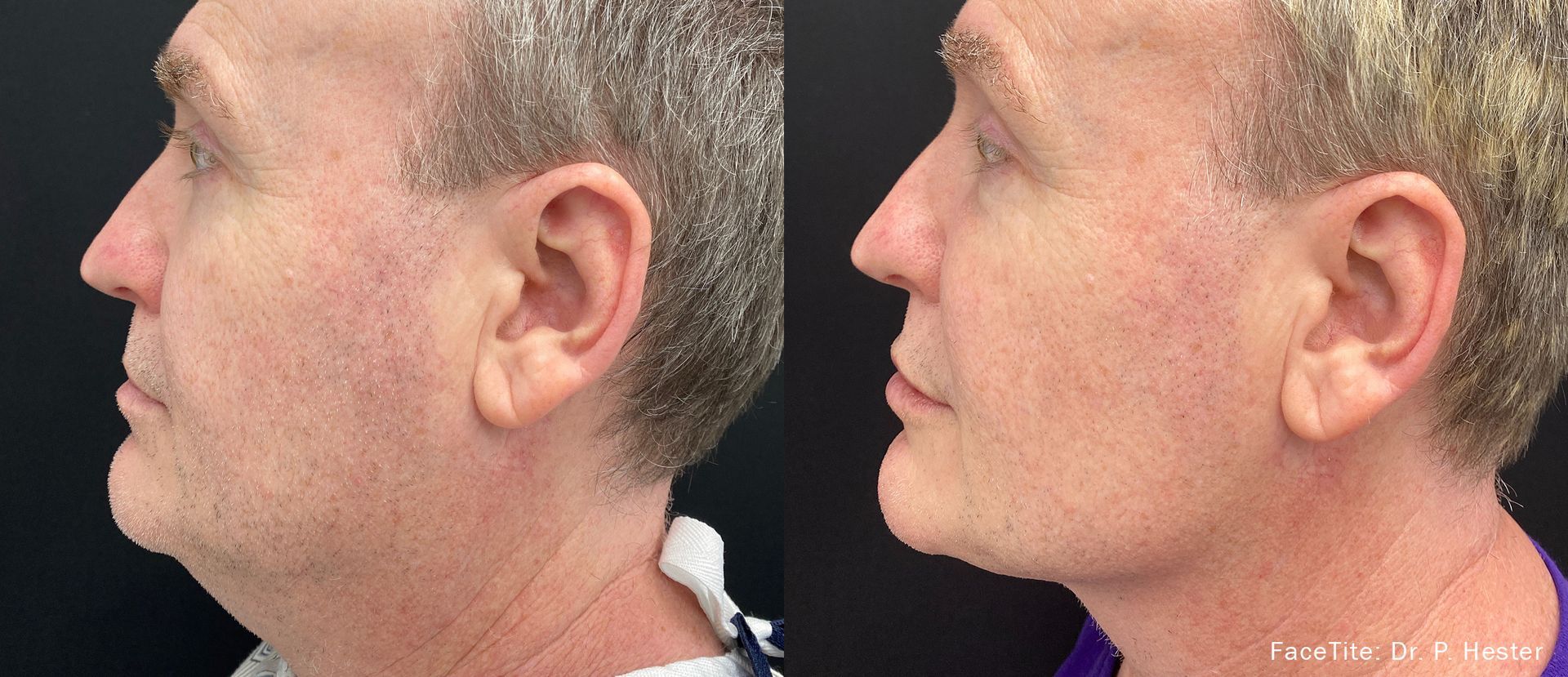 a patient shown before and after FaceTite treatment