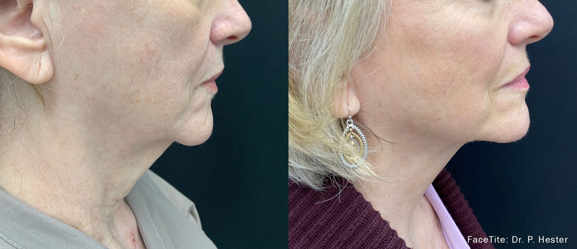 a patient shown before and after FaceTite treatment