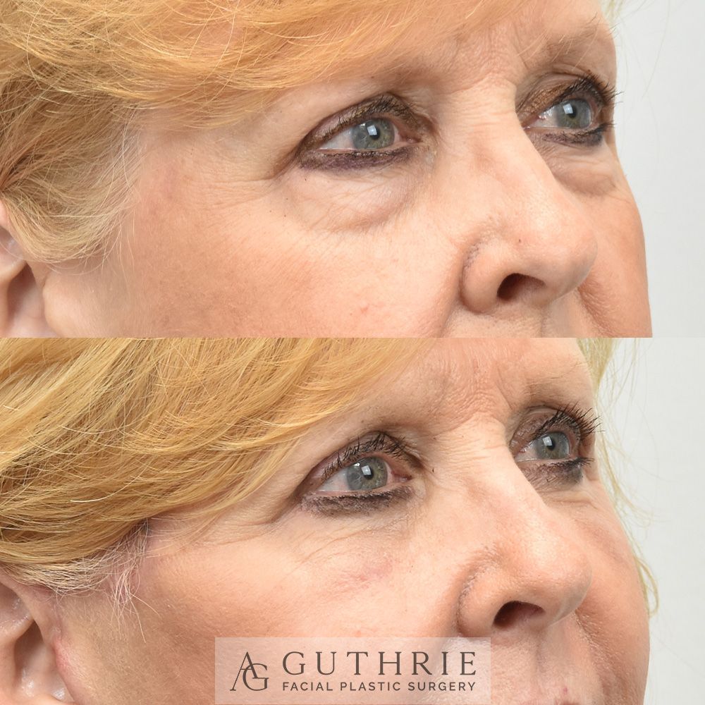 a mature blonde woman's face before and after lower blepharoplasty by Dr. Ashley Guthrie