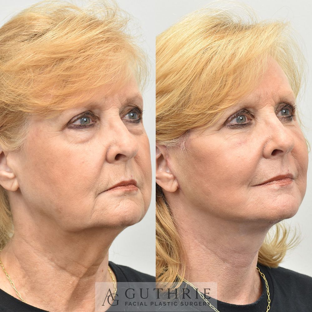 a mature blonde woman's face before and after buccal fat reduction procedure by Dr. Ashley Guthrie