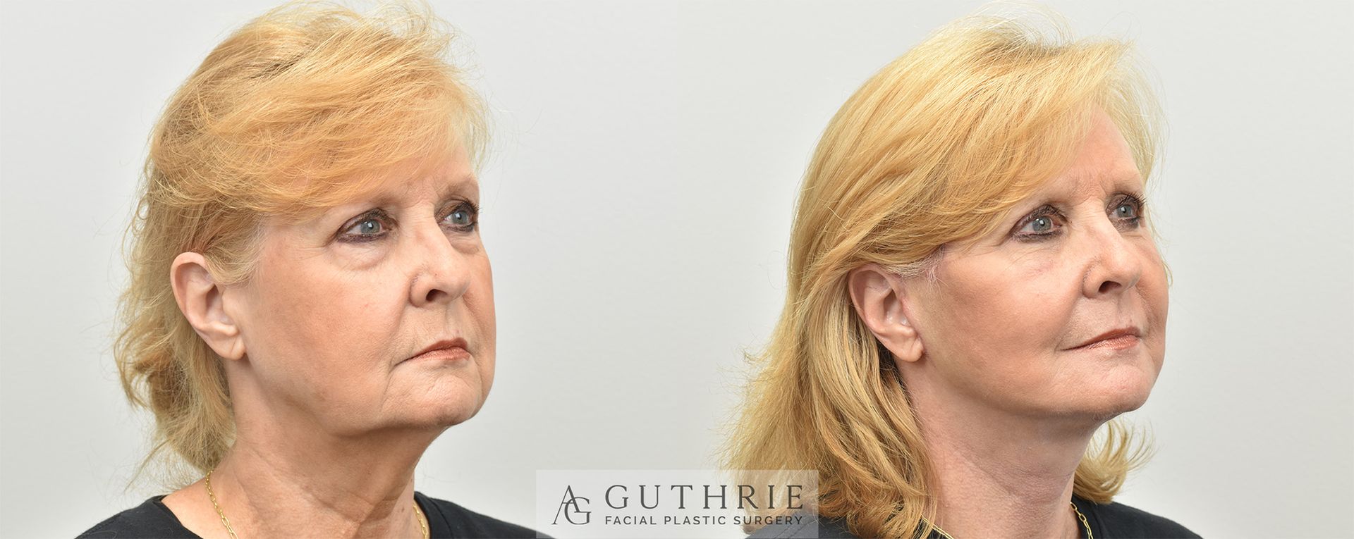 a mature blonde woman's face before and after deep plane facelift procedure by Dr. Ashley Guthrie