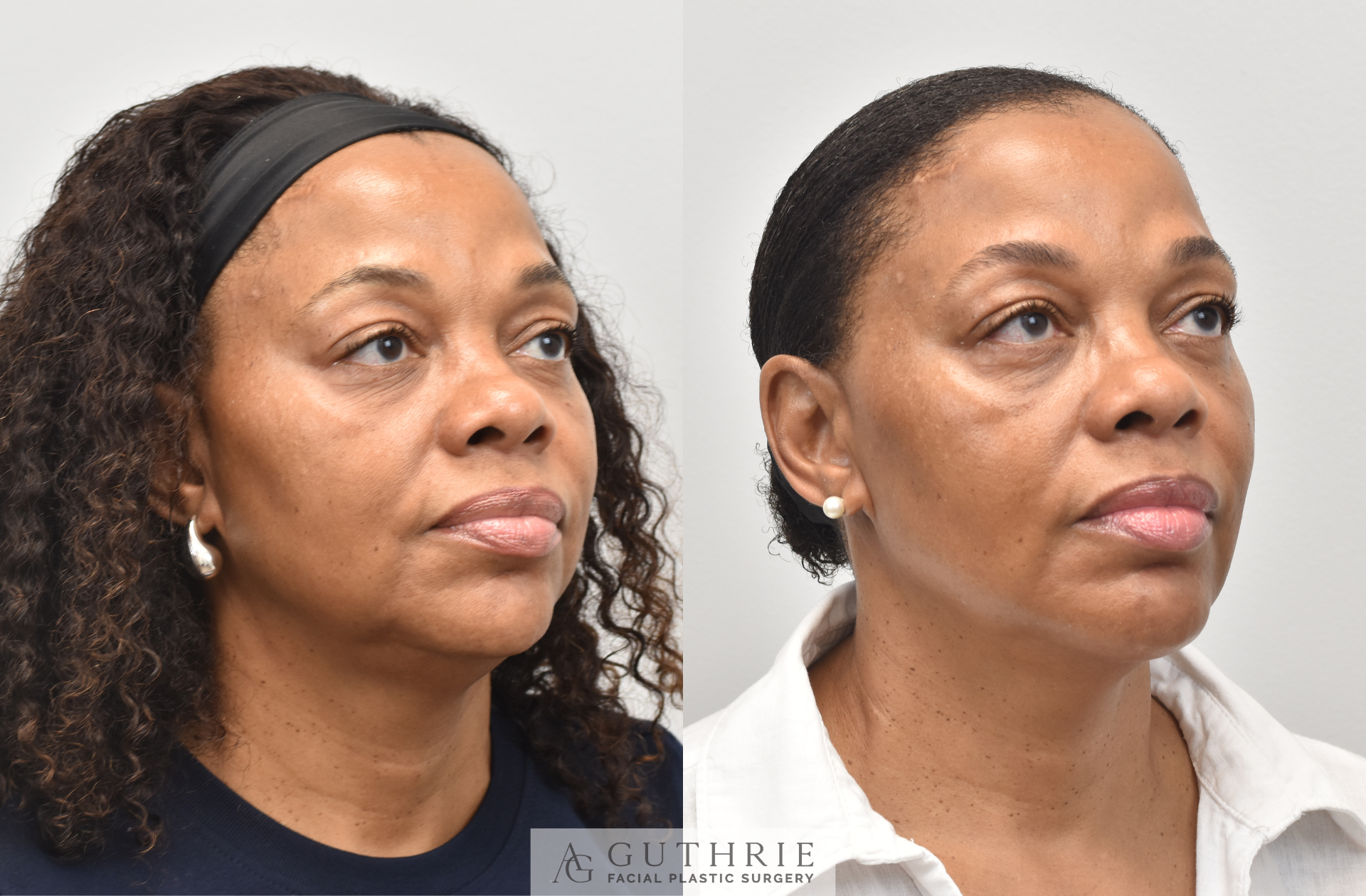 Guthrie Plastic Surgery patient before and after facelift