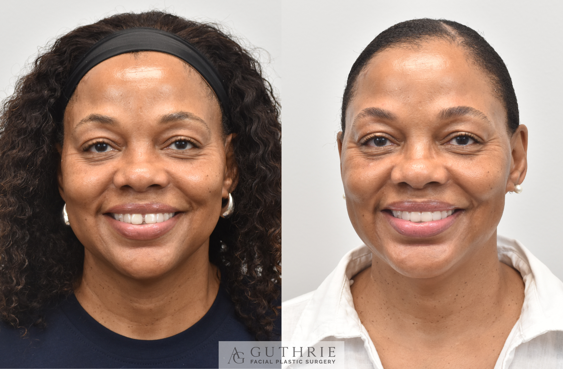 before & after - facial implants