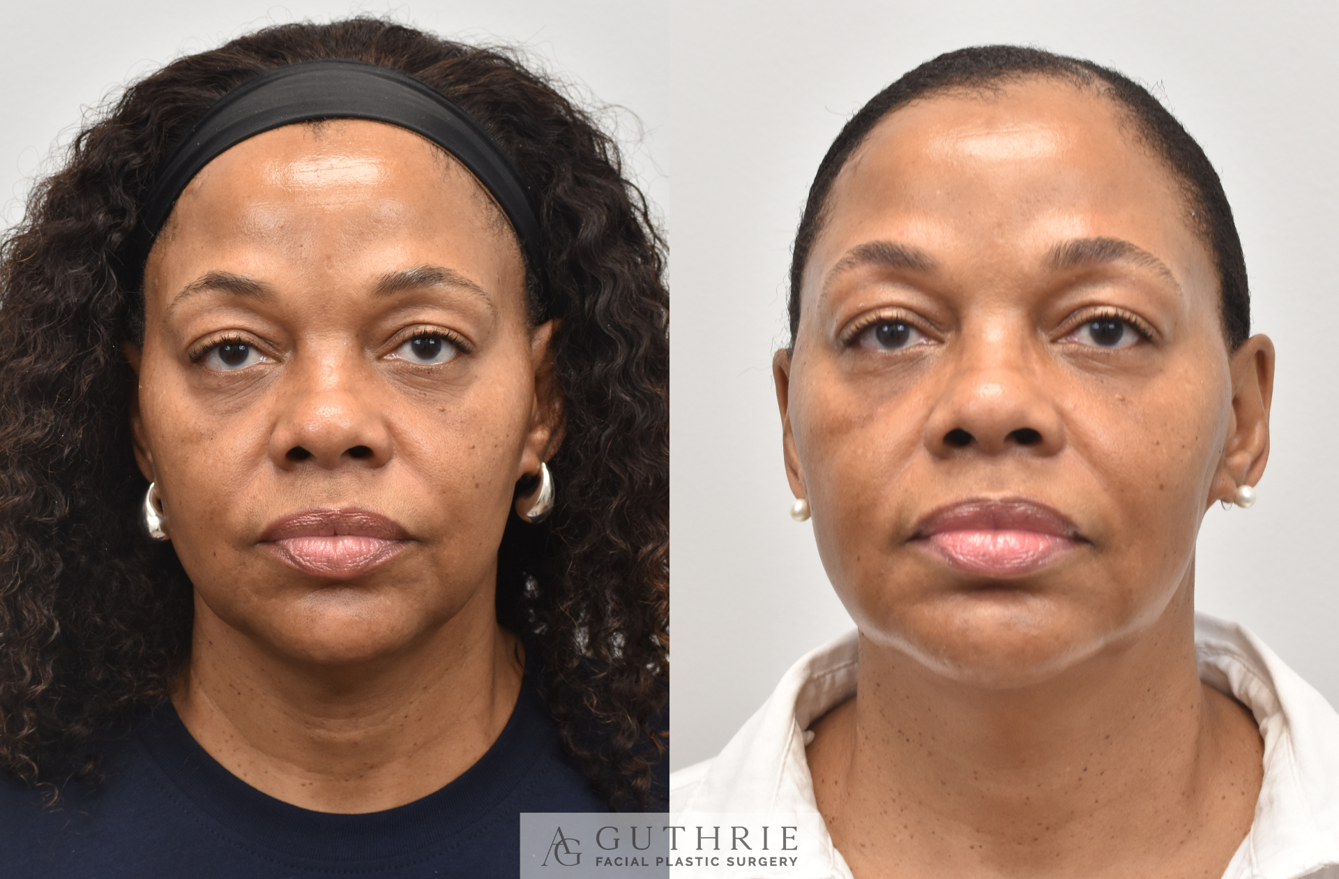 facial implants - before and after - performed by dr ashley guthrie