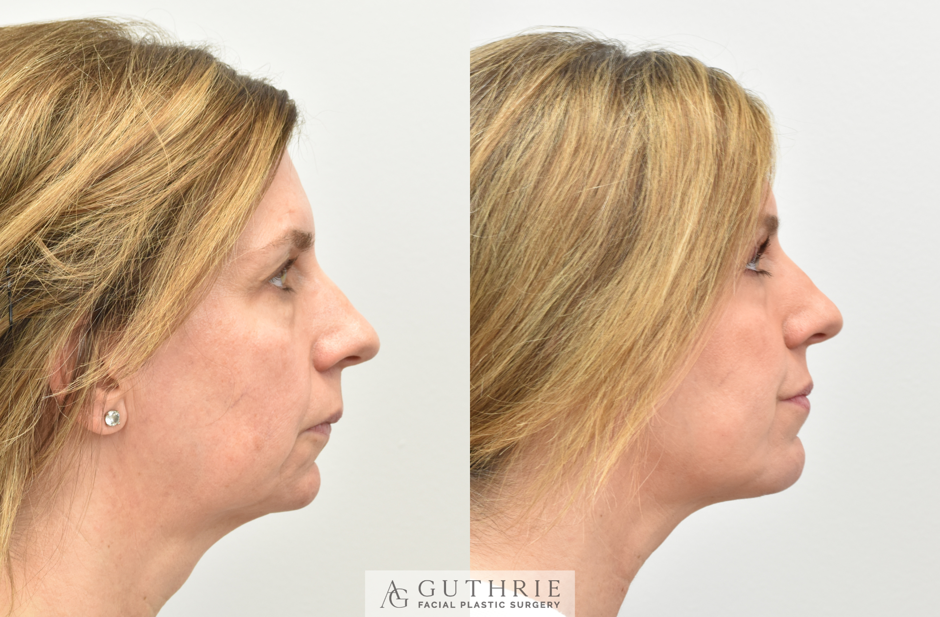 patient at guthrie facial plastic surgery before and after facial chin implants 