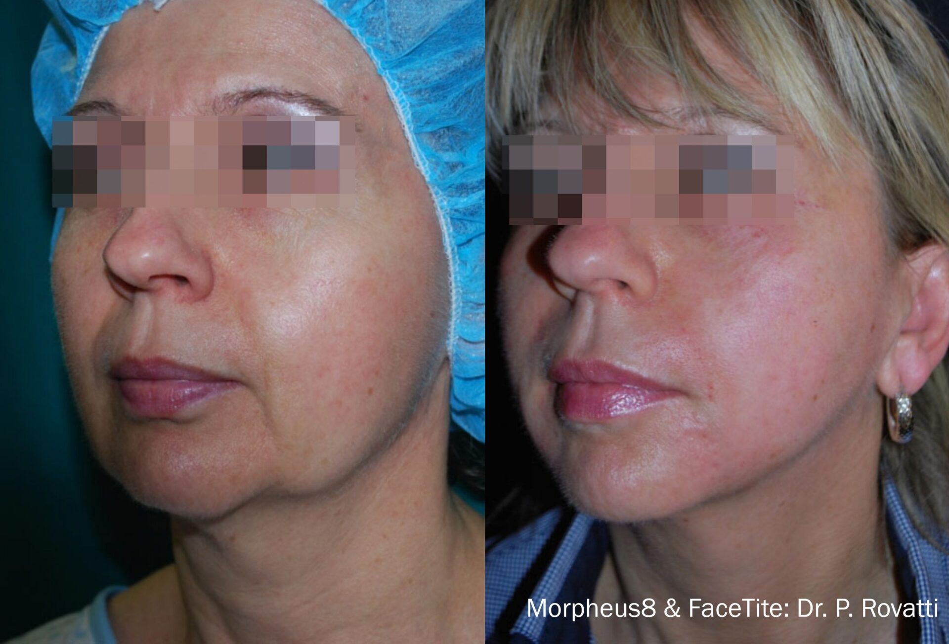 Before and After Morpheus8 Treatment, with FaceTite