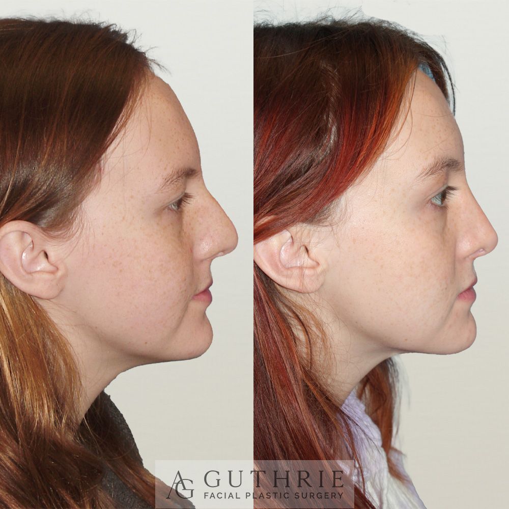 young woman's face before and after rhinoplasty performed by Dr. Ashley Guthrie