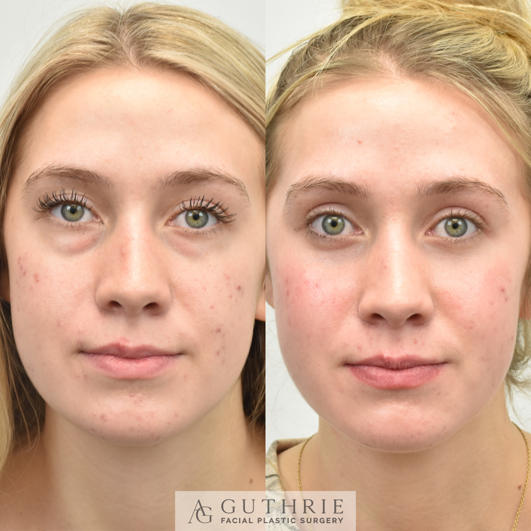 Before and After Lower Blepharoplasty