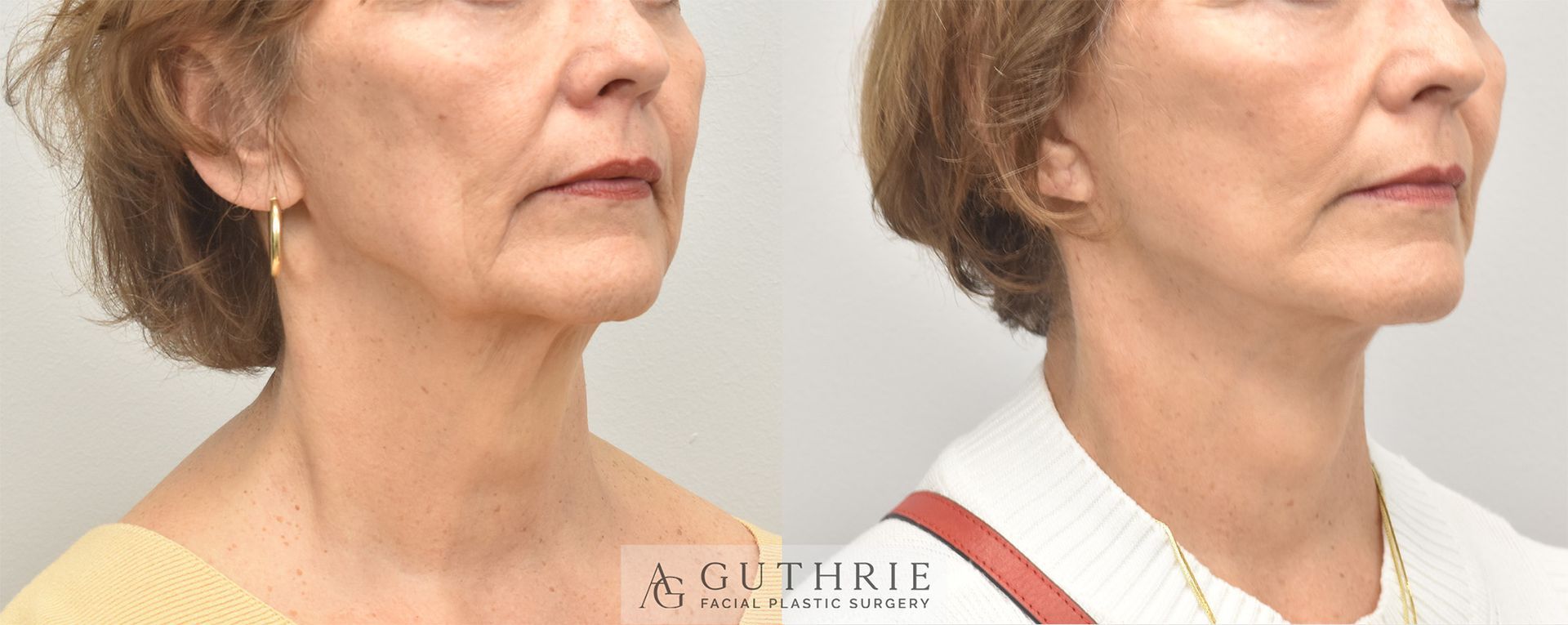 lower half of a woman's face and neck before and after facelift and necklift by Dr. Ashley Guthrie