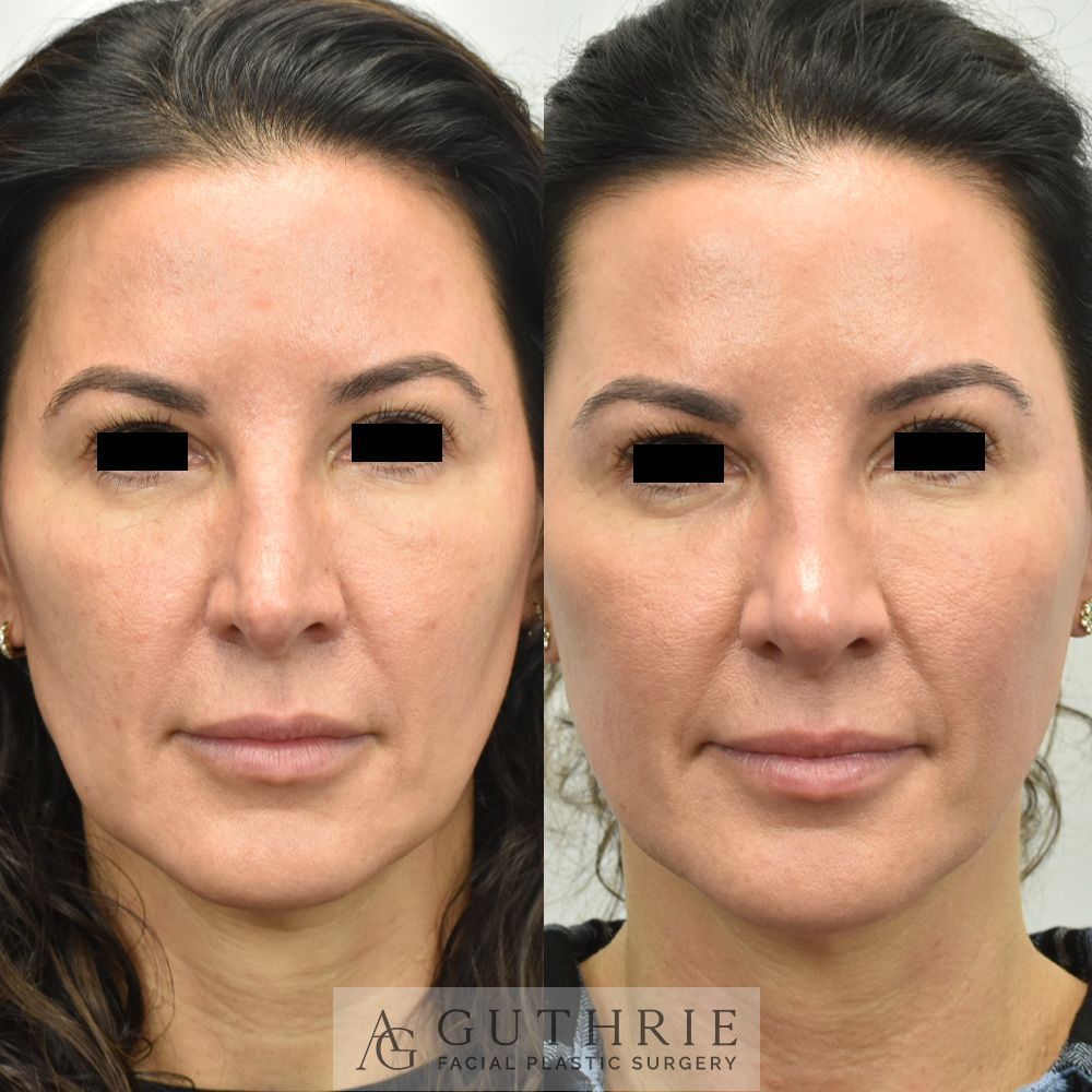 a woman shown Before and After Rhinoplasty