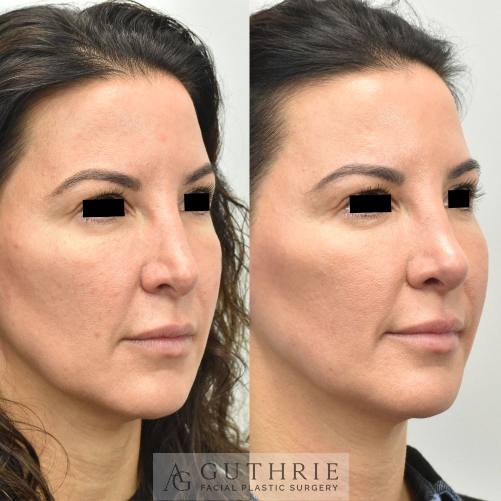a before and after photo of a woman 's face