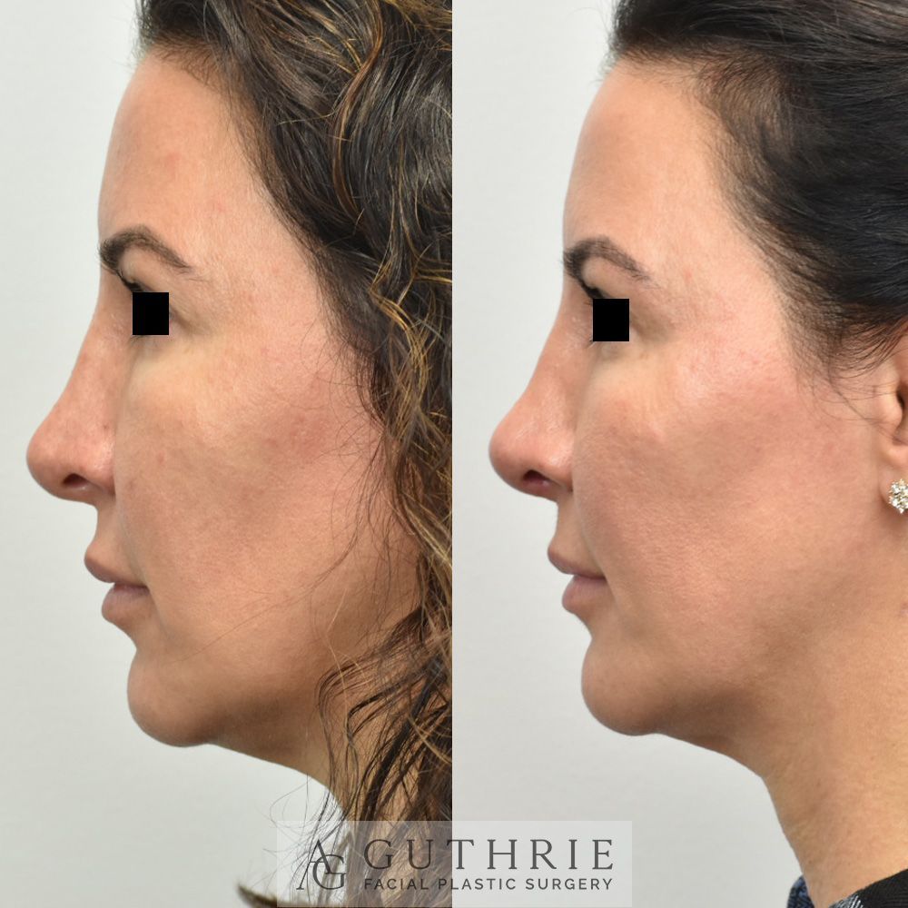 a before and after photo of a woman 's nose surgery .