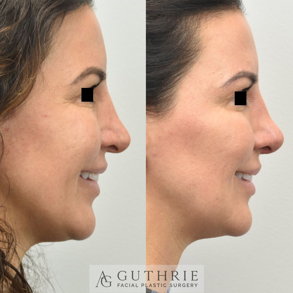 a before and after photo of a woman 's nose surgery