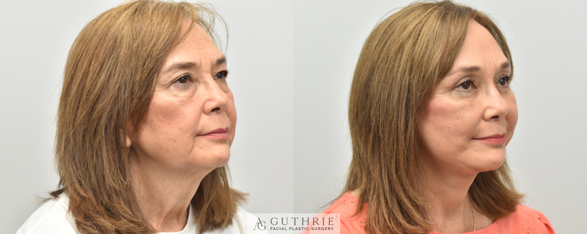 patient before and after facelift at guthrie facial plastic surgery in brentwood tn
