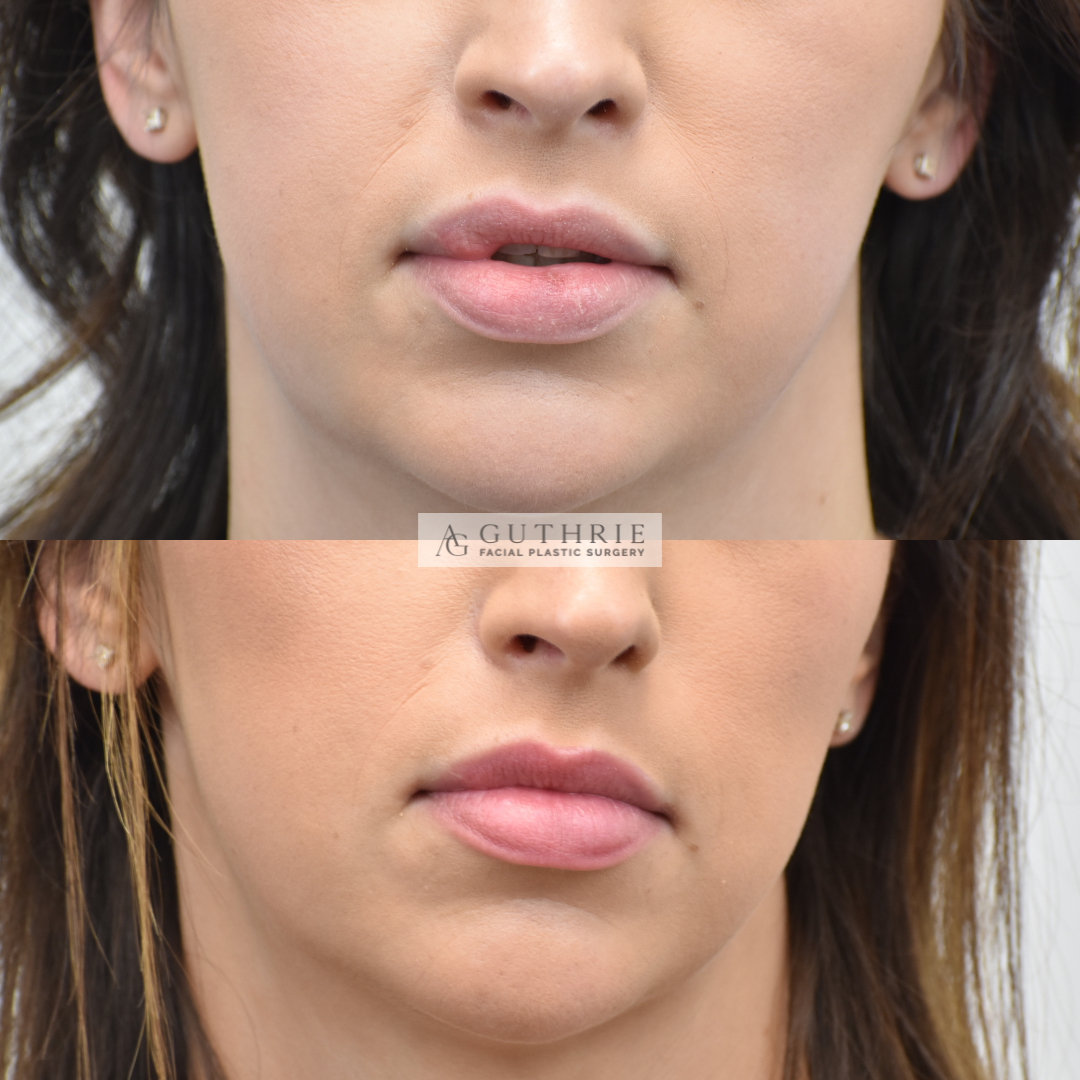 Before and After Lip Reduction and Scar Revision
