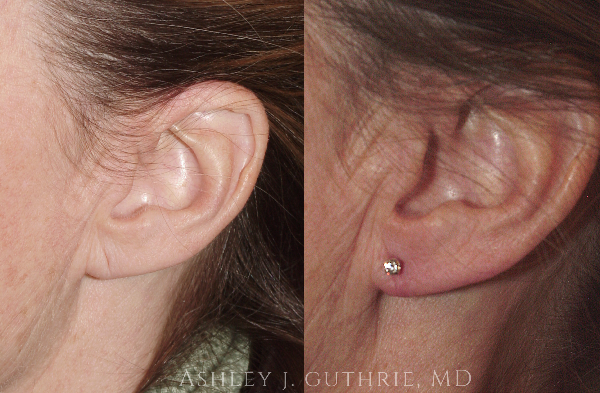 woman before and after earlobe reduction