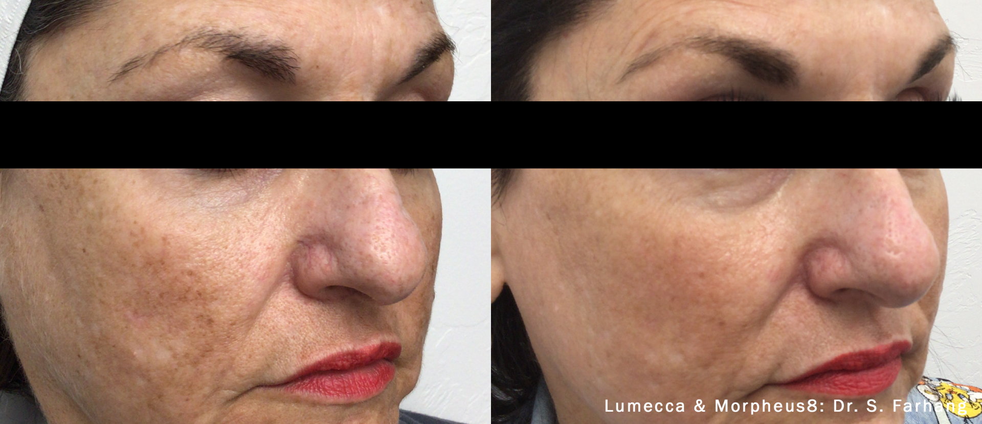 patient's face Before and After Morpheus8 Treatment, with FaceTite