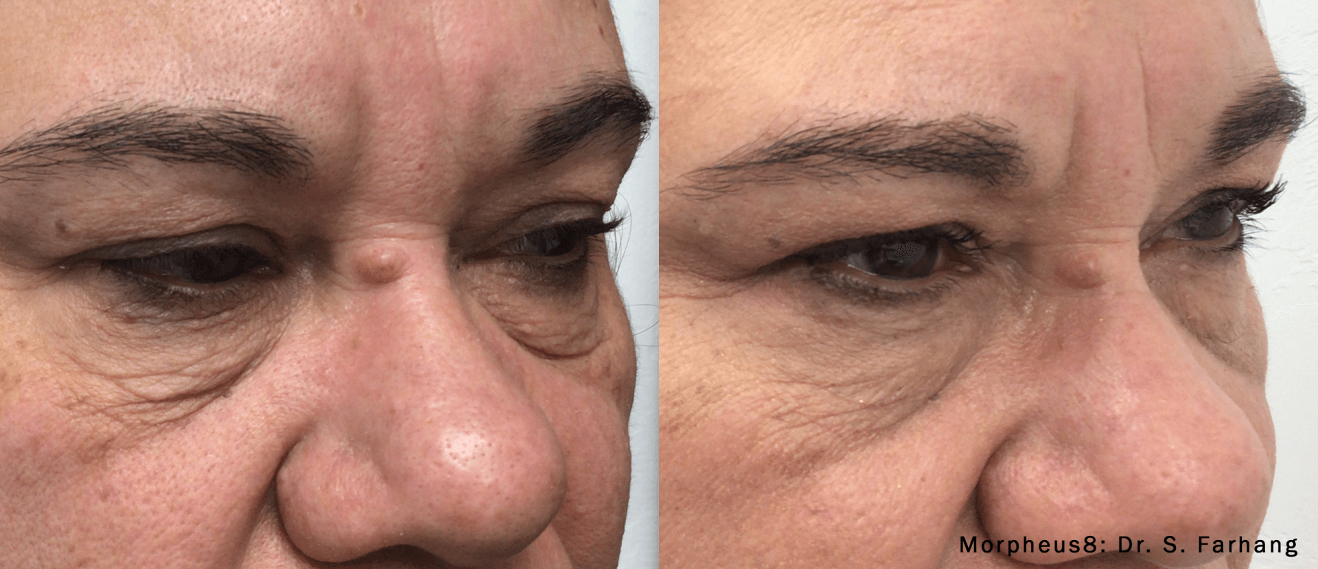 closeup of patient's face Before and After Morpheus8 Treatment