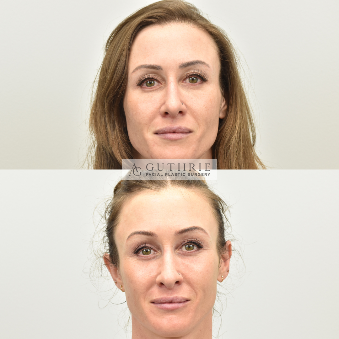 Before and After Brow Lift