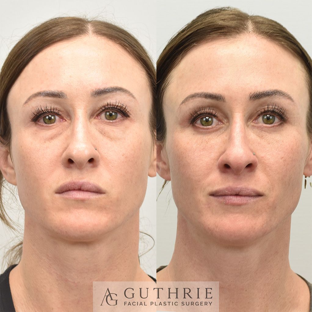 closeup of a woman's face shown before and after Upper and Lower Eyelid lift surgery by Dr. Ashley Guthrie