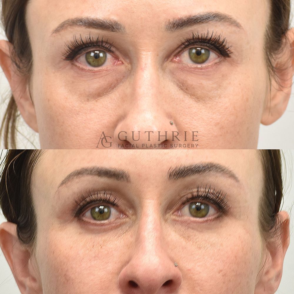 Before and After Upper and Lower Blepharoplasty with Fat Grafting
