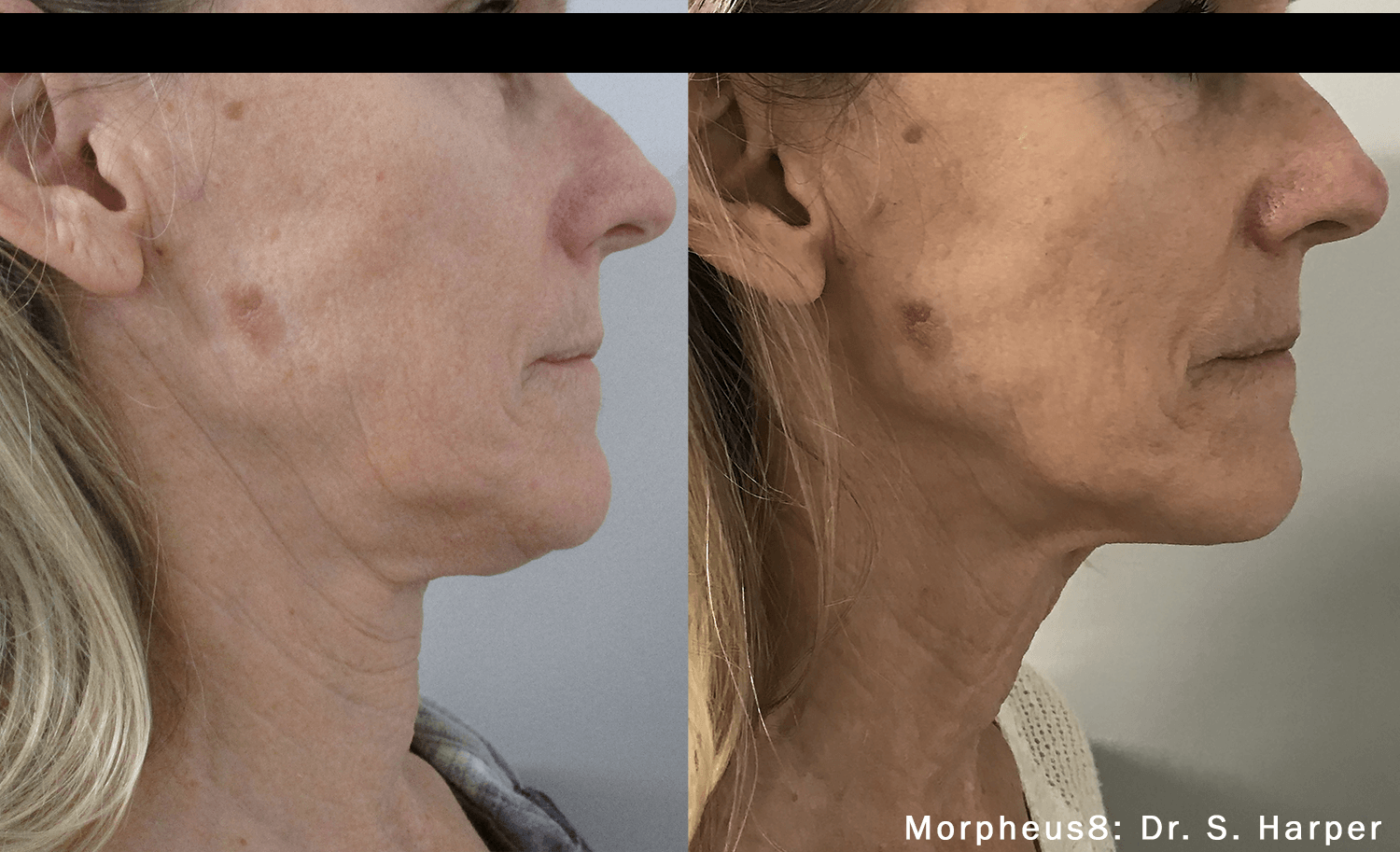 patient's face Before and After Morpheus8 Treatment