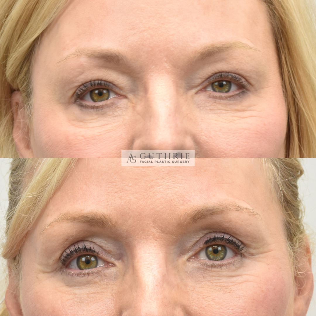 patient at guthrie facial plastic surgery before and after upper and lower blepharoplasty - eyelid lift