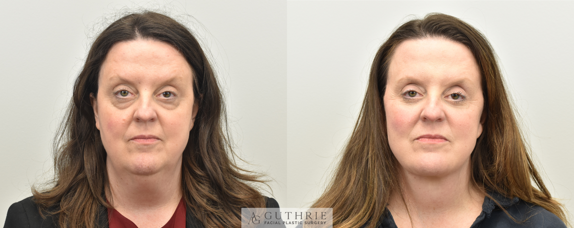patient at guthrie facial plastic surgery before and after facelift procedure brentwood tn